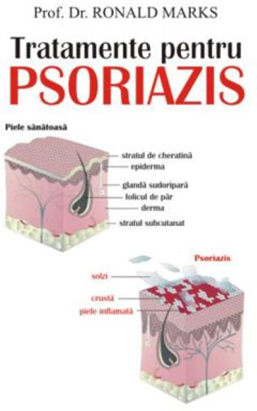 Tratamente pentru psoriazis - Prof. dr. Ronald Marks