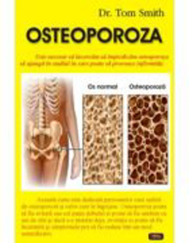 Osteoporoza - Dr. Tom Smith
