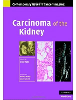 Carcinoma of the Kidney - Uday Patel