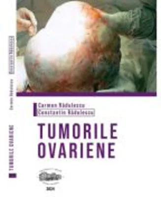 Tumorile ovariene (alb-negru) - Carmen Radulescu