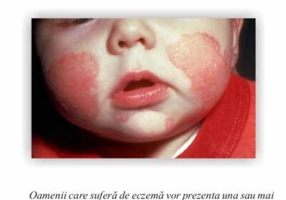 Cum să faci faţă eczemei - Paperback brosat - Jill Eckersley - Antet Revolution