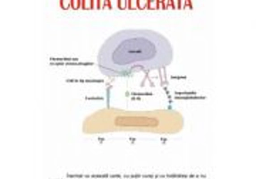 Colita ulcerata - Peter Cartwright